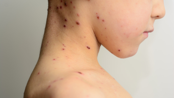 Mässling: orsak, symtom & behandling